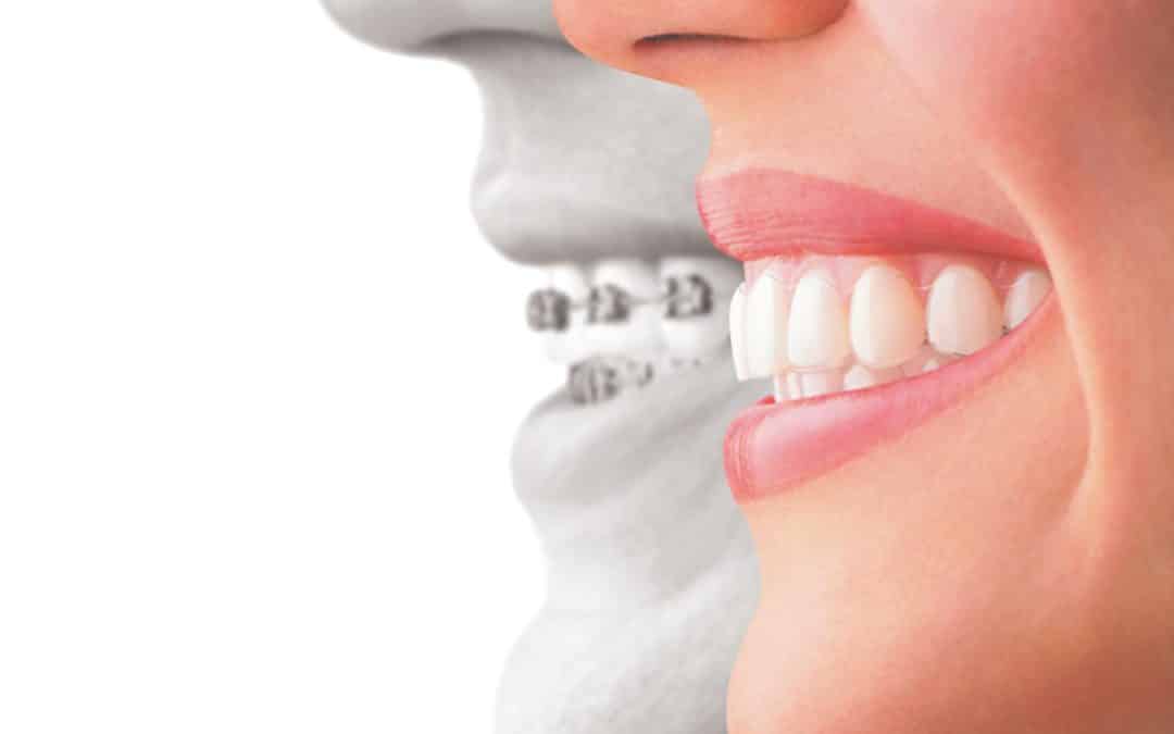 Ask Your Wichita Falls Dentist: What’s the difference between Invisalign and Metal Braces?