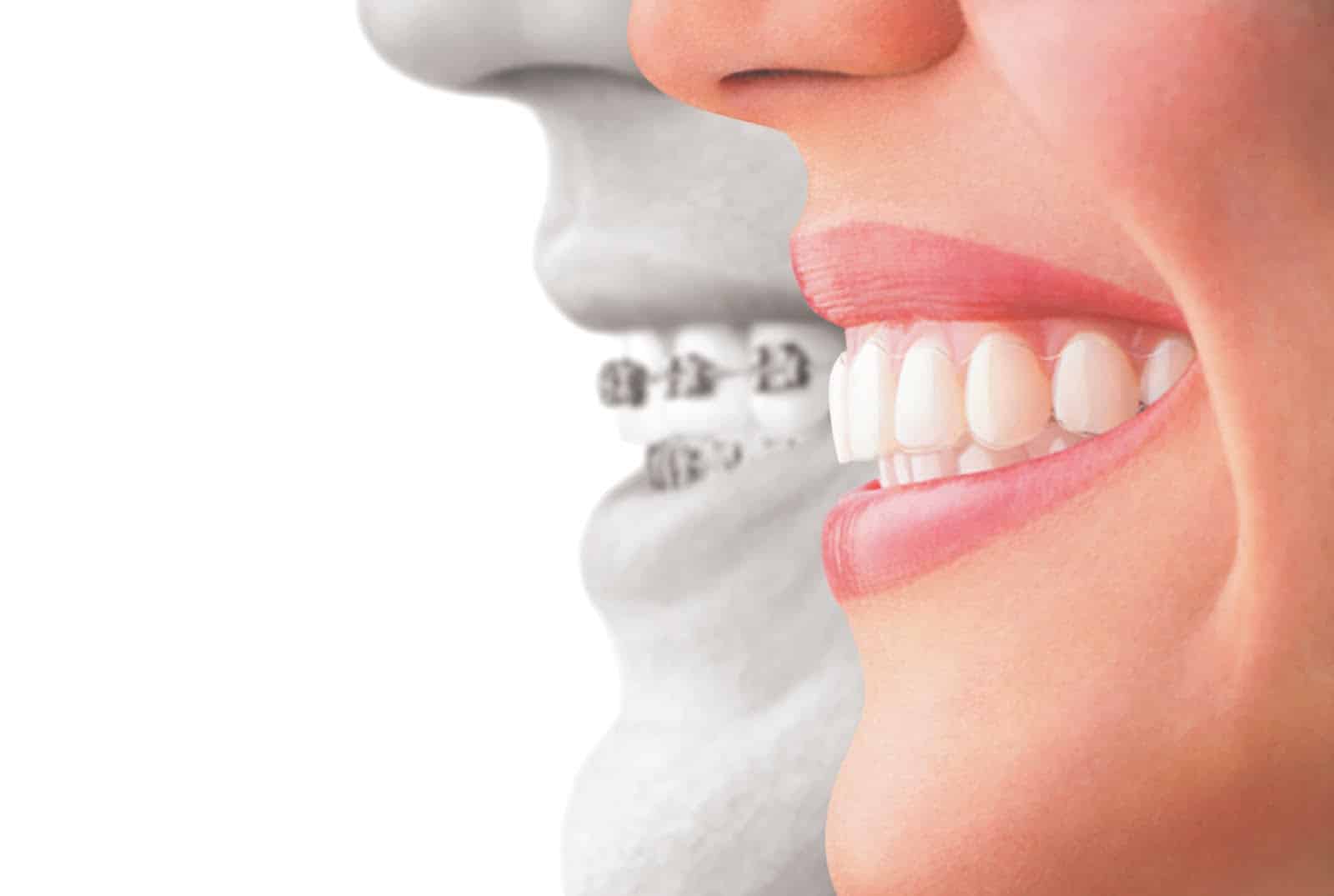 Ask Your Wichita Falls Dentist: What's the difference between Invisalign  and Metal Braces?, Spearmint Dental & Orthodontics