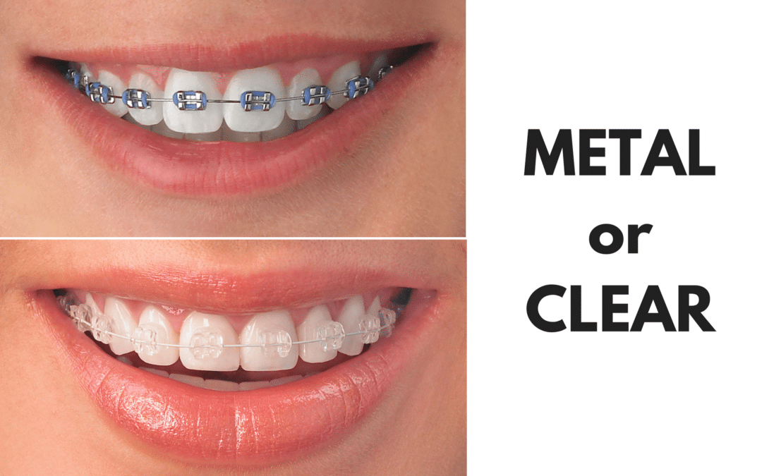 Ask Your Wichita Falls Dentist: Should I Get Metal or Clear Braces?