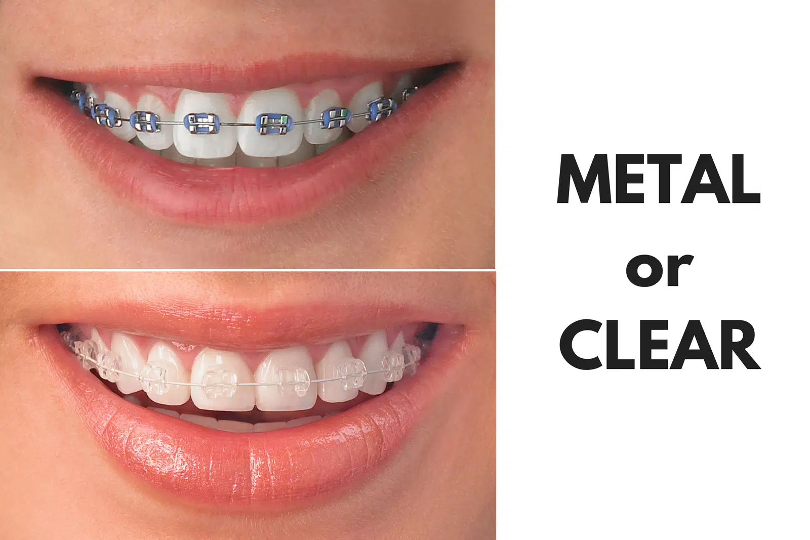 Ask Your Wichita Falls Dentist: Should I Get Metal or Clear Braces