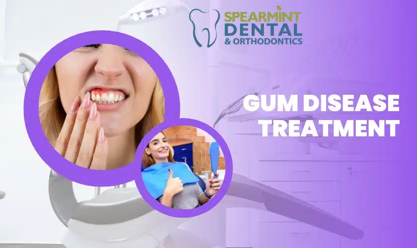 Top 4 Benefits Of Gum Disease Treatment