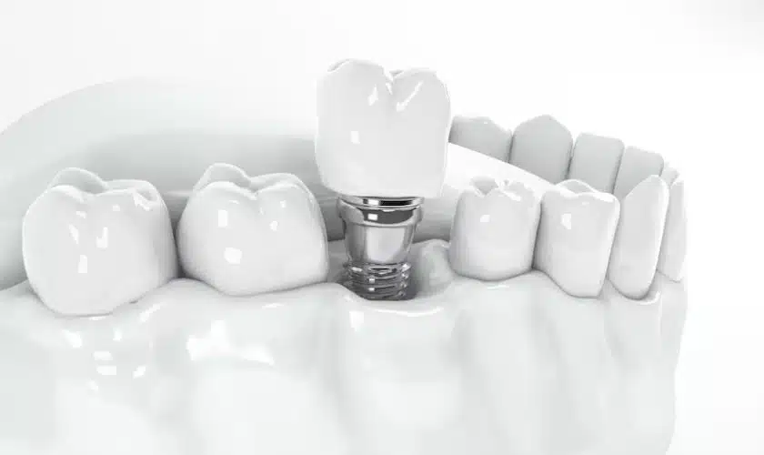 5 Benefits Of Dental Implants: Beyond Aesthetics