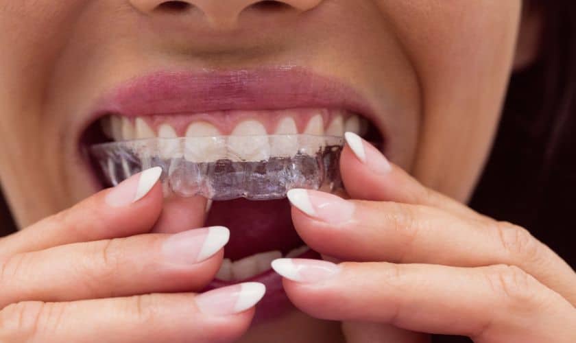 Know 7 Benefits of Invisalign Teeth Aligners - Dentistry At Its Finest