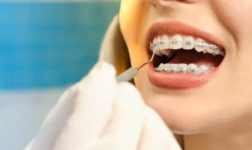 The Importance of Retainers: Post-Orthodontic Care