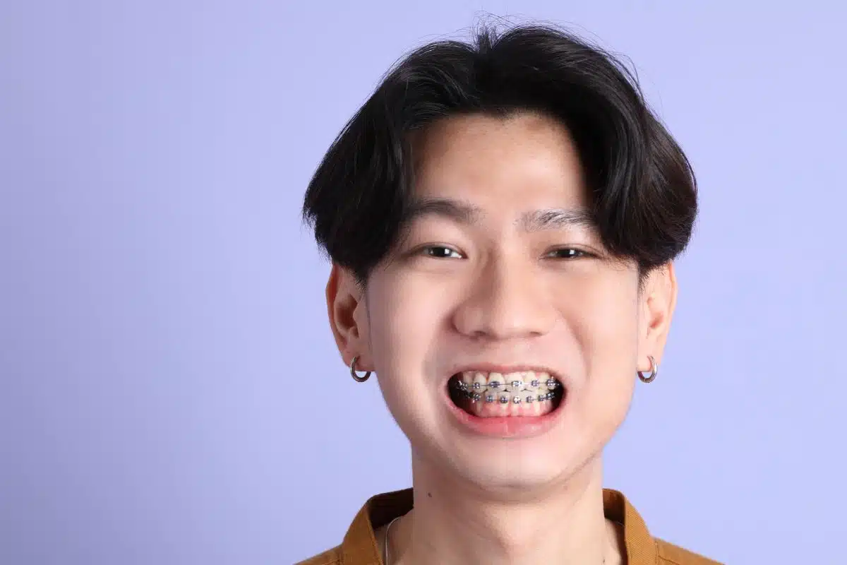 How to Stop Gum Overgrowth with Braces